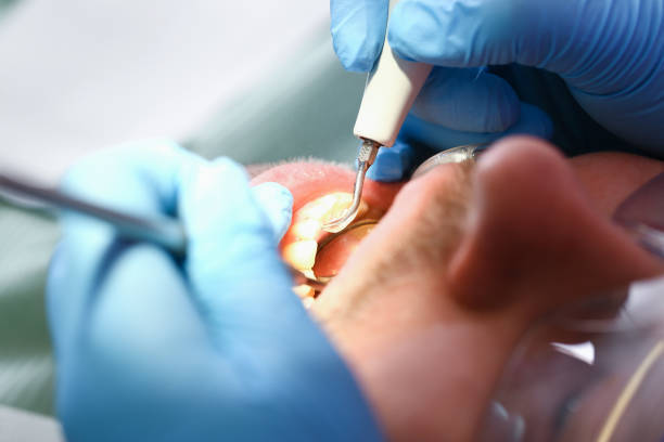 Best Broken or Chipped Tooth Repair in Lower Lake, CA