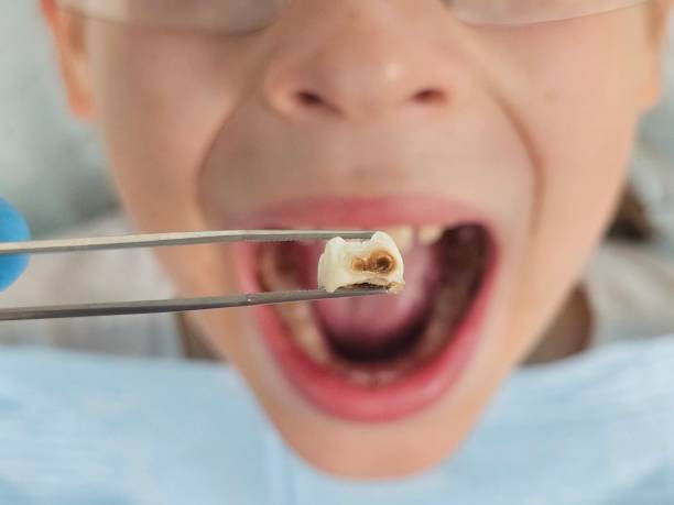 Best Emergency Root Canal Therapy in Lower Lake, CA